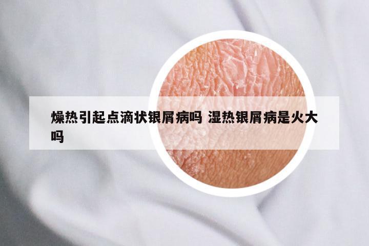 燥热引起点滴状银屑病吗 湿热银屑病是火大吗