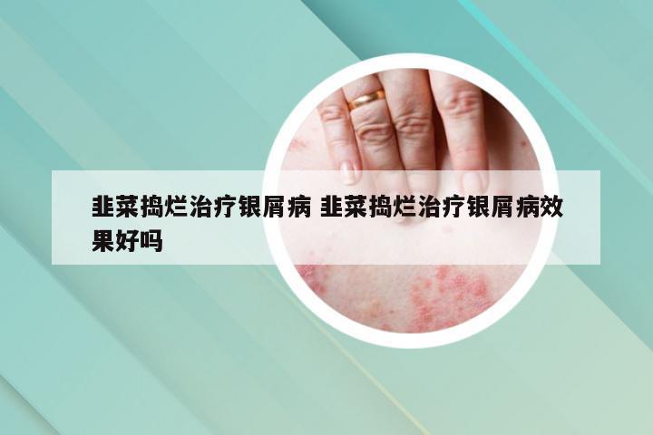 韭菜捣烂治疗银屑病 韭菜捣烂治疗银屑病效果好吗