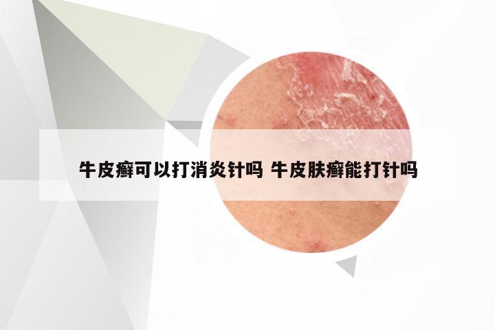 牛皮癣可以打消炎针吗 牛皮肤癣能打针吗