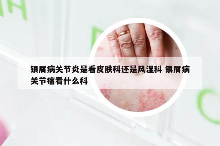 银屑病关节炎是看皮肤科还是风湿科 银屑病关节痛看什么科
