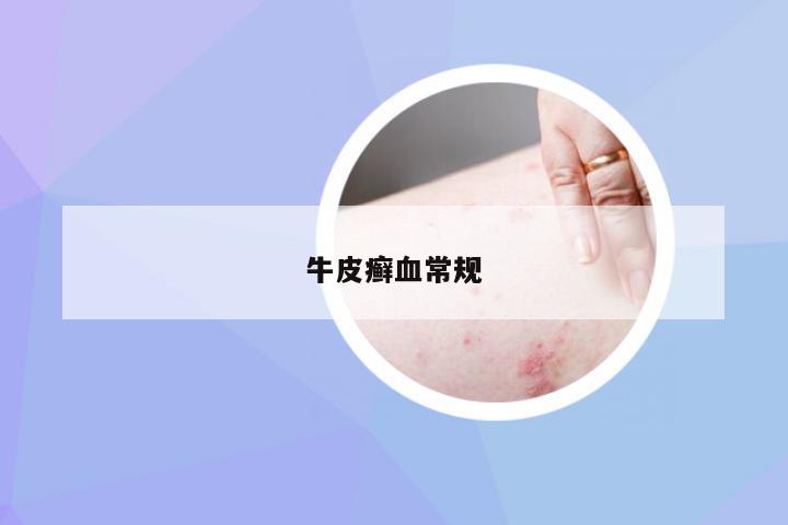 牛皮癣血常规