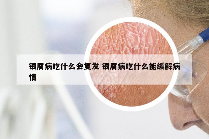 银屑病吃什么会复发 银屑病吃什么能缓解病情