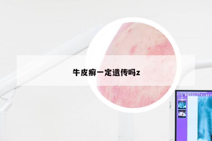 牛皮癣一定遗传吗z