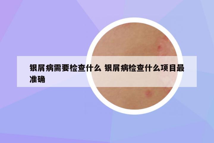 银屑病需要检查什么 银屑病检查什么项目最准确