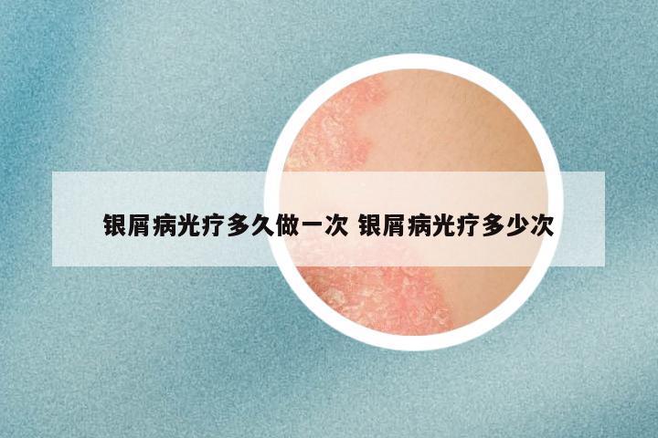 银屑病光疗多久做一次 银屑病光疗多少次