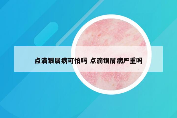 点滴银屑病可怕吗 点滴银屑病严重吗