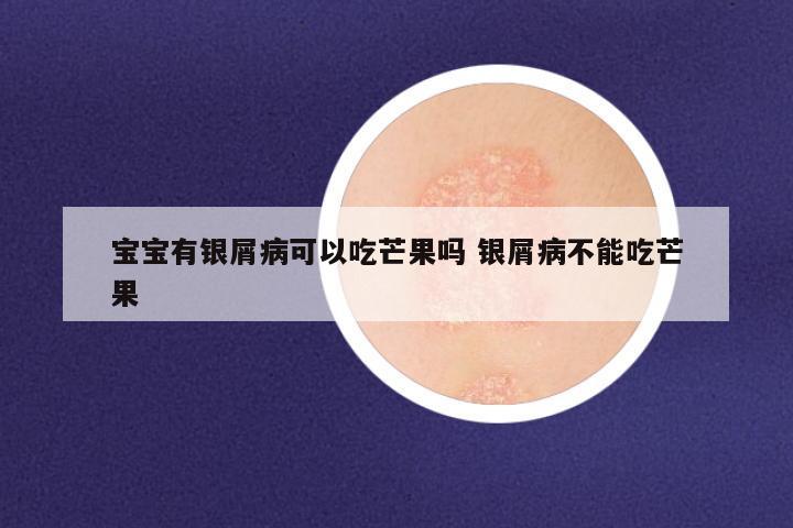 宝宝有银屑病可以吃芒果吗 银屑病不能吃芒果
