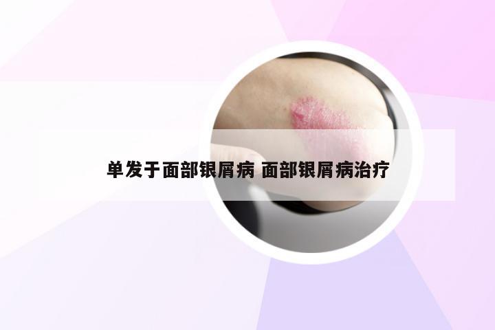 单发于面部银屑病 面部银屑病治疗