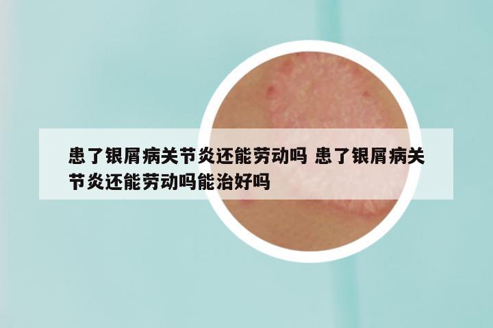 患了银屑病关节炎还能劳动吗 患了银屑病关节炎还能劳动吗能治好吗