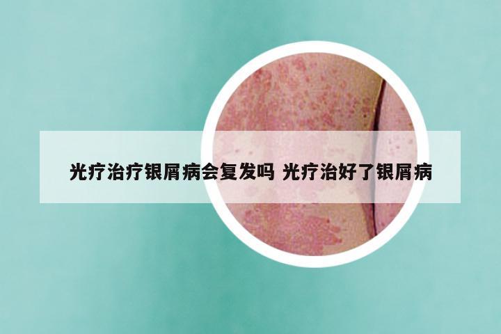 光疗治疗银屑病会复发吗 光疗治好了银屑病