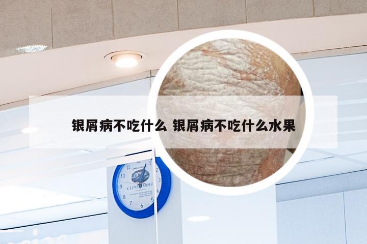 银屑病不吃什么 银屑病不吃什么水果