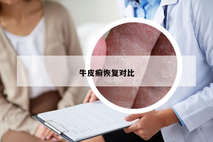 牛皮癣恢复对比