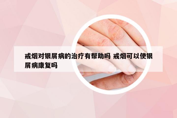戒烟对银屑病的治疗有帮助吗 戒烟可以使银屑病康复吗
