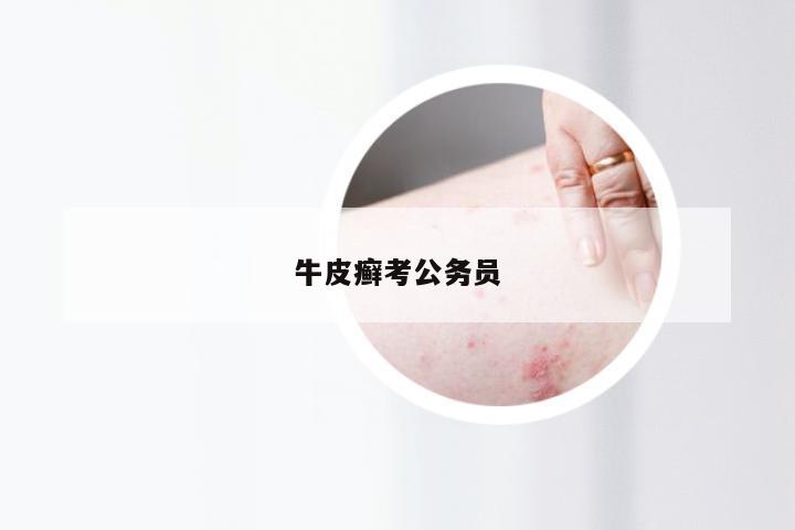 牛皮癣考公务员
