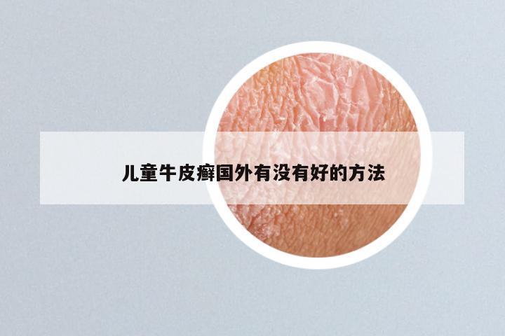 儿童牛皮癣国外有没有好的方法
