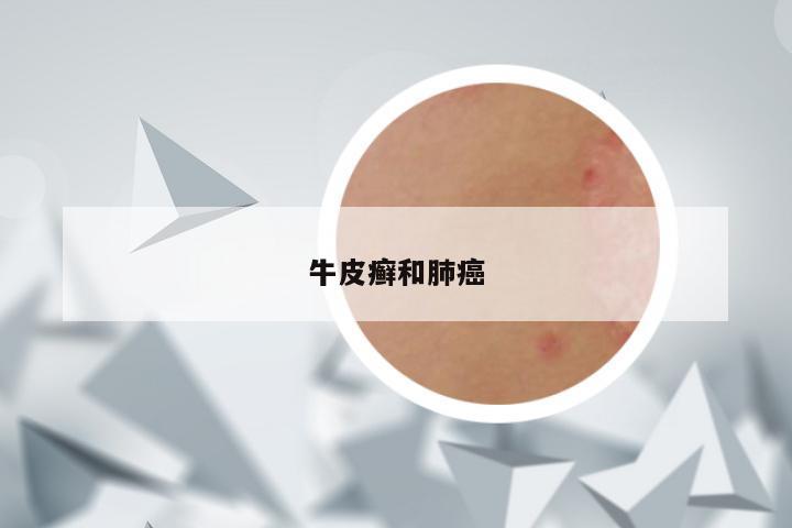 牛皮癣和肺癌