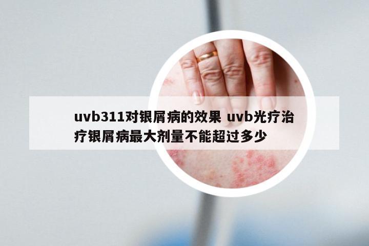 uvb311对银屑病的效果 uvb光疗治疗银屑病最大剂量不能超过多少