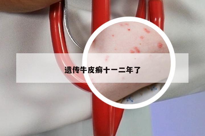 遗传牛皮癣十一二年了
