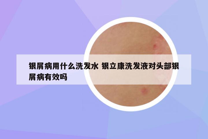 银屑病用什么洗发水 银立康洗发液对头部银屑病有效吗