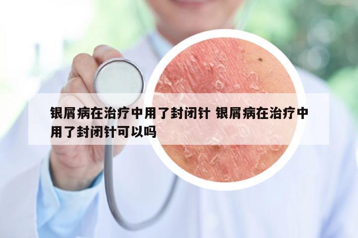 银屑病在治疗中用了封闭针 银屑病在治疗中用了封闭针可以吗