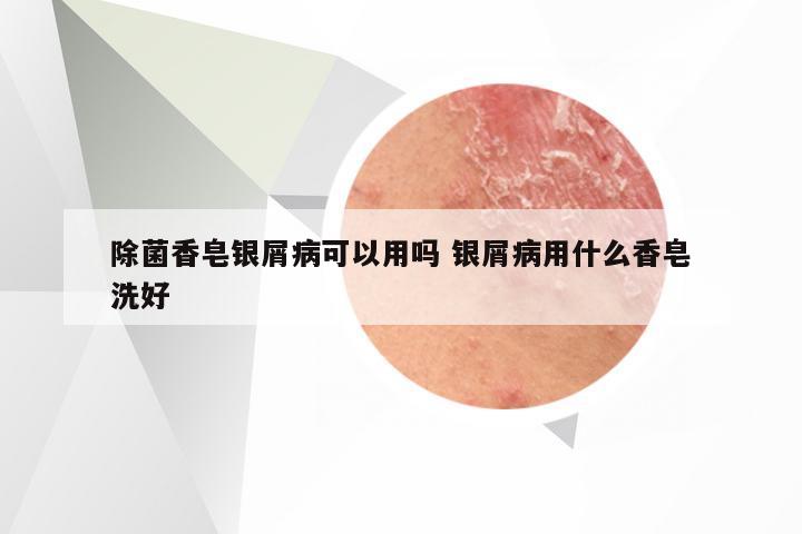 除菌香皂银屑病可以用吗 银屑病用什么香皂洗好