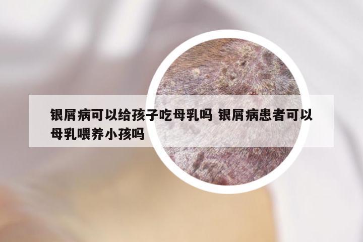 银屑病可以给孩子吃母乳吗 银屑病患者可以母乳喂养小孩吗