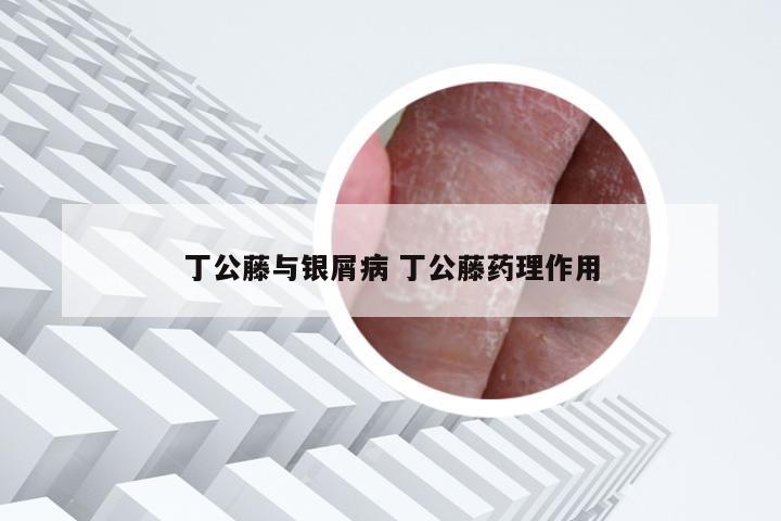 丁公藤与银屑病 丁公藤药理作用