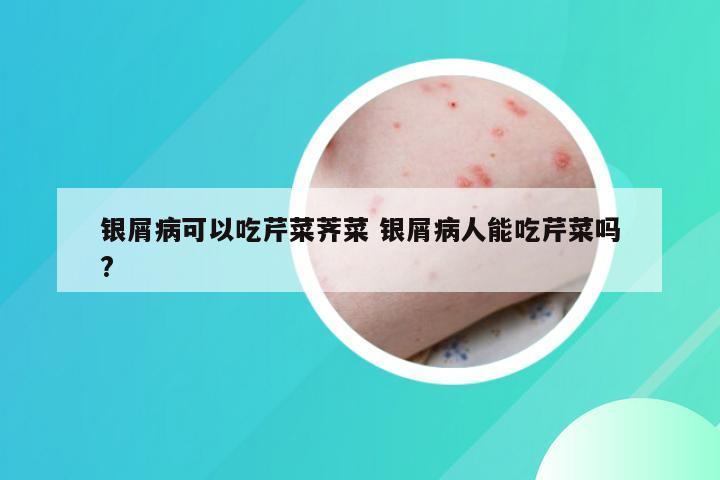 银屑病可以吃芹菜荠菜 银屑病人能吃芹菜吗?