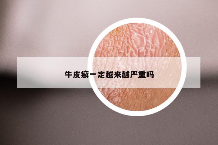 牛皮癣一定越来越严重吗