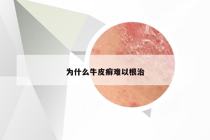 为什么牛皮癣难以根治
