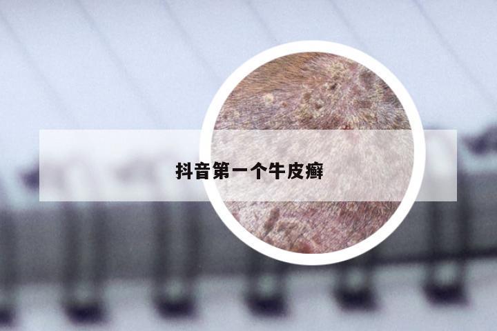 抖音第一个牛皮癣