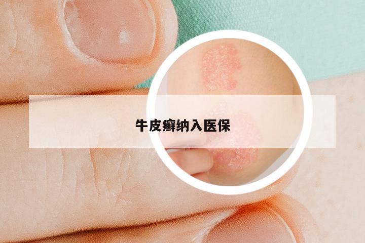 牛皮癣纳入医保