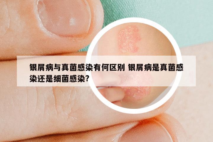 银屑病与真菌感染有何区别 银屑病是真菌感染还是细菌感染?