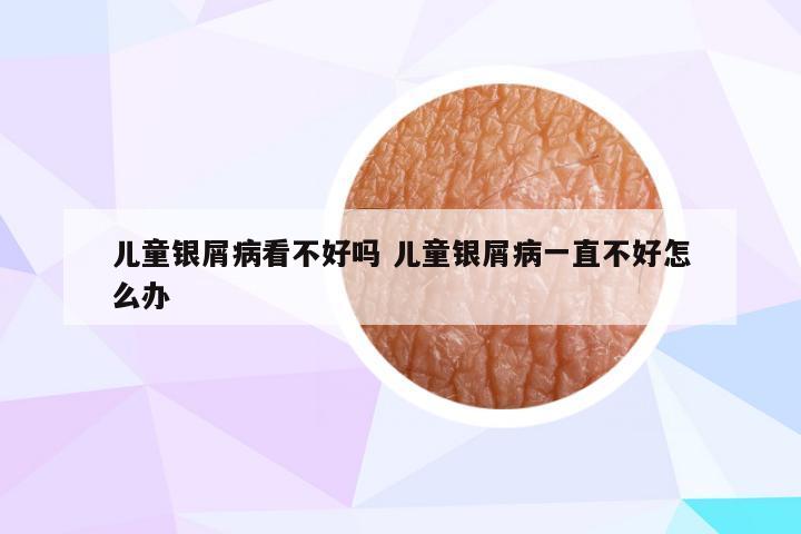 儿童银屑病看不好吗 儿童银屑病一直不好怎么办