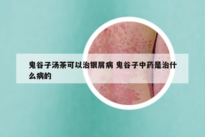 鬼谷子汤茶可以治银屑病 鬼谷子中药是治什么病的