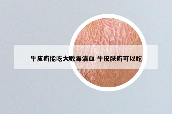 牛皮癣能吃大败毒清血 牛皮肤癣可以吃