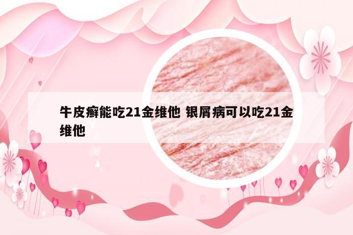 牛皮癣能吃21金维他 银屑病可以吃21金维他
