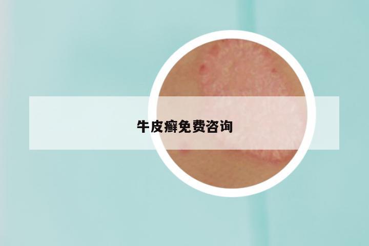 牛皮癣免费咨询