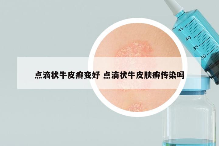 点滴状牛皮癣变好 点滴状牛皮肤癣传染吗