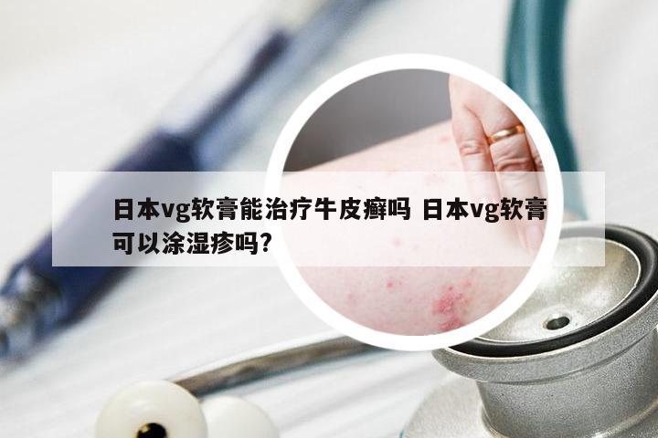 日本vg软膏能治疗牛皮癣吗 日本vg软膏可以涂湿疹吗?