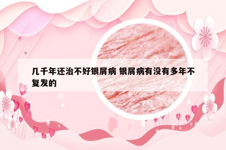 几千年还治不好银屑病 银屑病有没有多年不复发的