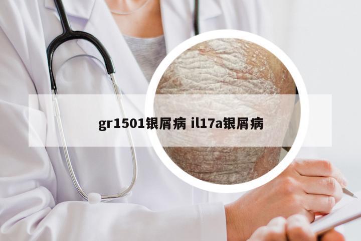 gr1501银屑病 il17a银屑病