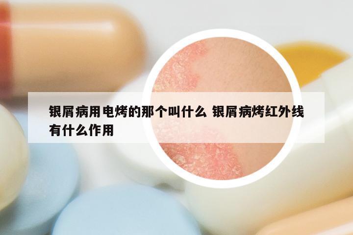 银屑病用电烤的那个叫什么 银屑病烤红外线有什么作用