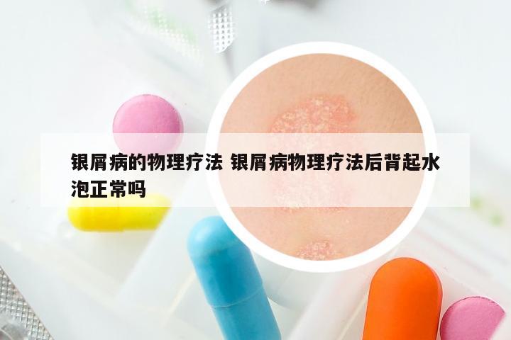 银屑病的物理疗法 银屑病物理疗法后背起水泡正常吗