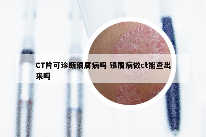 CT片可诊断银屑病吗 银屑病做ct能查出来吗