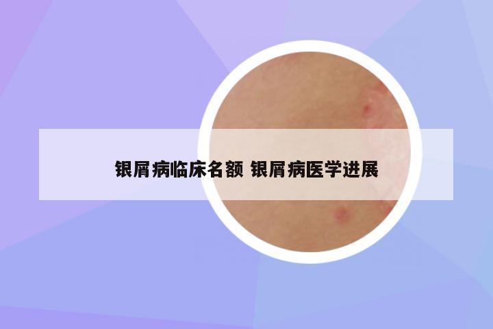 银屑病临床名额 银屑病医学进展