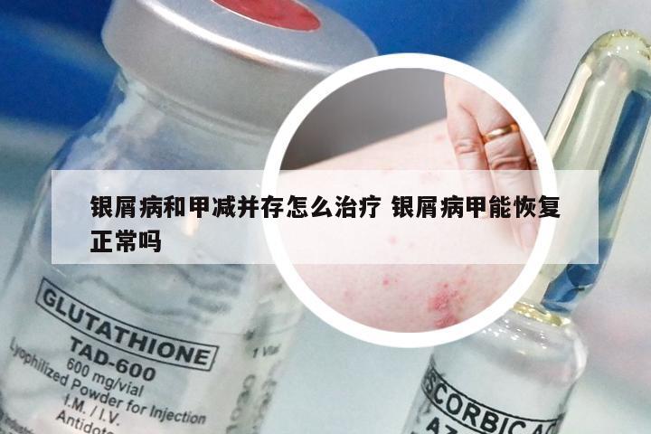 银屑病和甲减并存怎么治疗 银屑病甲能恢复正常吗
