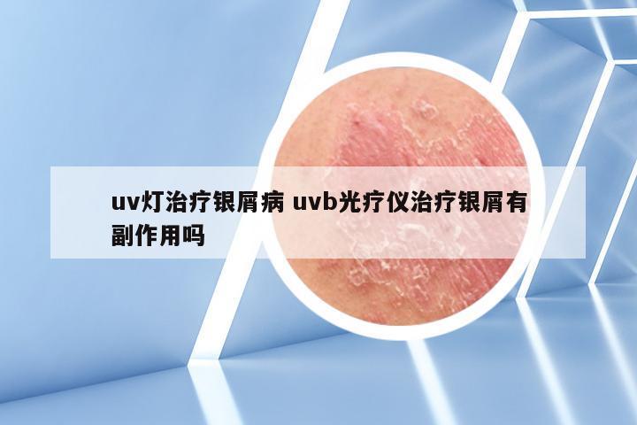 uv灯治疗银屑病 uvb光疗仪治疗银屑有副作用吗