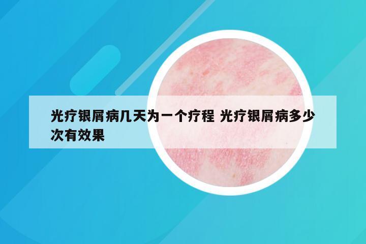 光疗银屑病几天为一个疗程 光疗银屑病多少次有效果