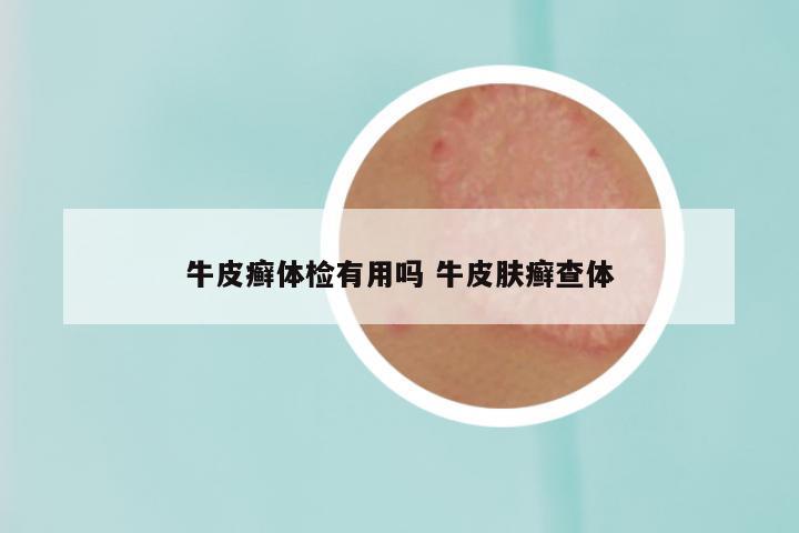 牛皮癣体检有用吗 牛皮肤癣查体